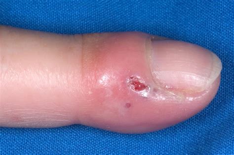 early stage whitlow pictures fingers treatment|herpetic whitlow finger infection pictures.